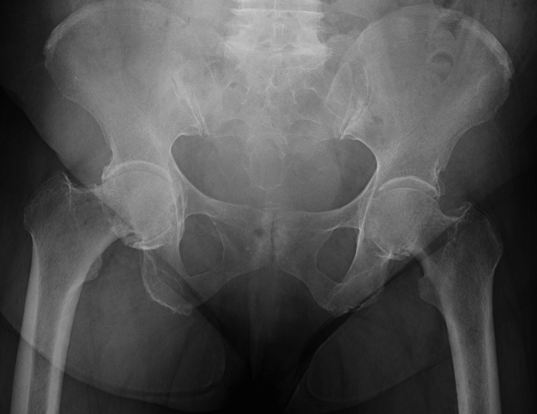 Bilateral severe coxa vara with OA